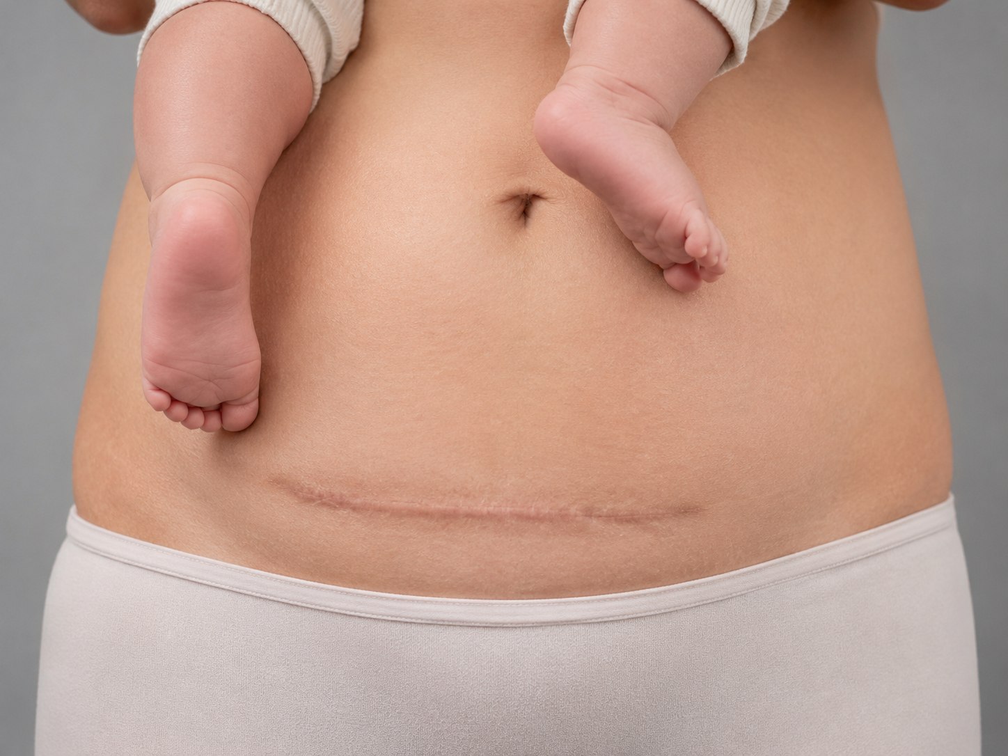 Cesarean delivery care